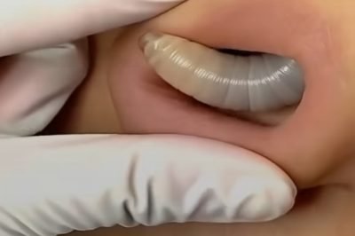 Larvae found in a young woman…See more