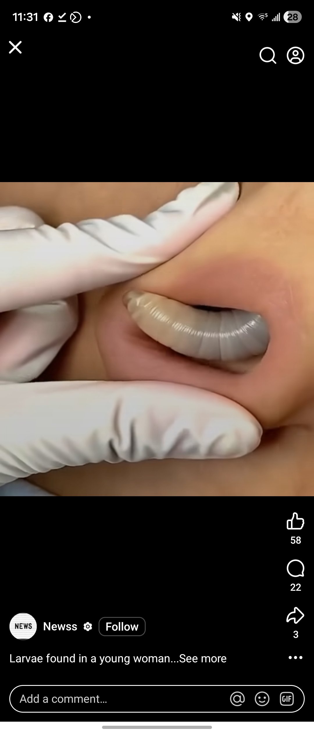 Larvae found in a young woman…See more