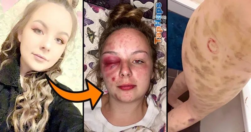 Severely Beaten Girl Reports Gang-Rape, Police Criminally Charge Her