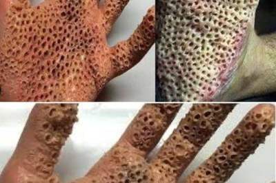 Have you noticed these red spots on your skin? Find out why they exist.