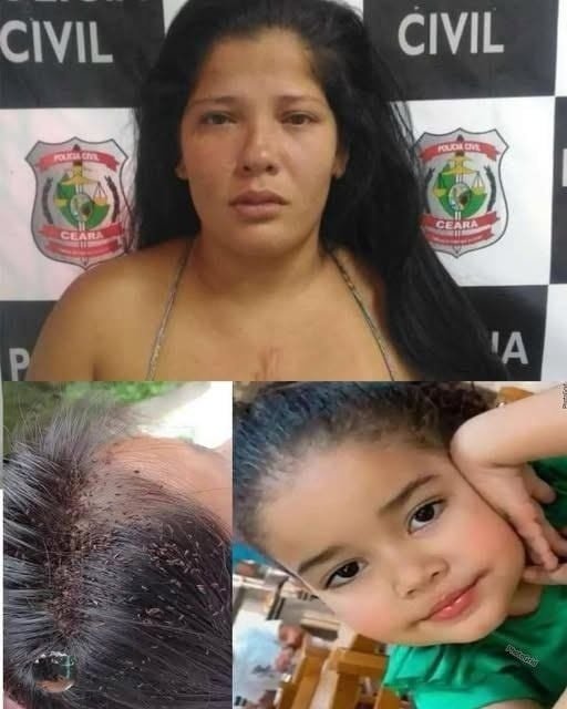 3-year-old girl after lice and mother warns…