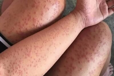 I Slept at my friends old apartment for a couple days noticed these weird bump…