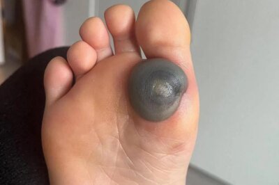 My daughter woke up with this huge spot on her foot…